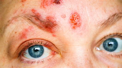 Rash Around Eyes: Causes and Treatment - GoodRx