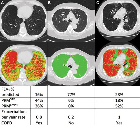 Small Airway Disease and Emphysema Are Associated with Future Exacerbations in Smokers with CT ...