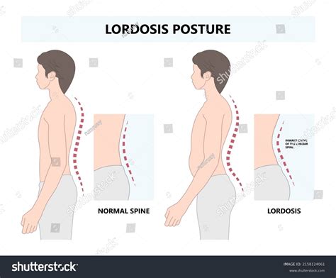 Lordosis