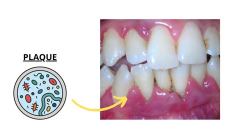 A Lump or Bump on Your Gum? Here’s What It Could Mean (Pictures)