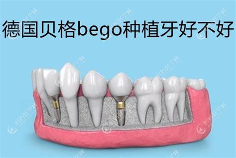 【基础篇】BEGO种植系统MultiPlus多牙系统你用对了吗？|牙科种植|陕西嘉友科贸有限公司
