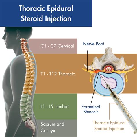 Injection Back Pain 的图像结果