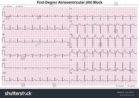 First Degree Av Block Summary Of Heart Blocks 1st Degree Heart Block: