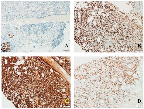 Rare Breast Carcinoma with Paradoxical Plasma Cell Immunoprofile: A ...