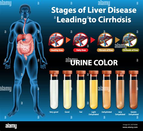 Liver cirrhosis drawing hi-res stock photography and images - Alamy