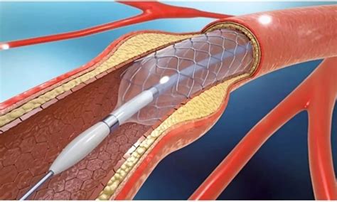 New Drug-Eluting Balloon Matches Standard Stents in Safety and ...