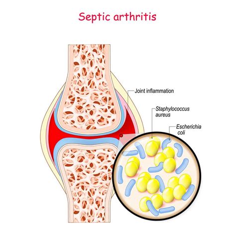 Septic Arthritis - Orthopaedic Wellness Links