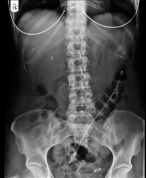 Radiopaedia case Migrated common bile duct stent id: 75714 study: 87056 - NC Commons