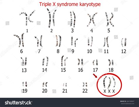 22 Triple x syndrome: immagini, foto stock e grafica vettoriale | Shutterstock