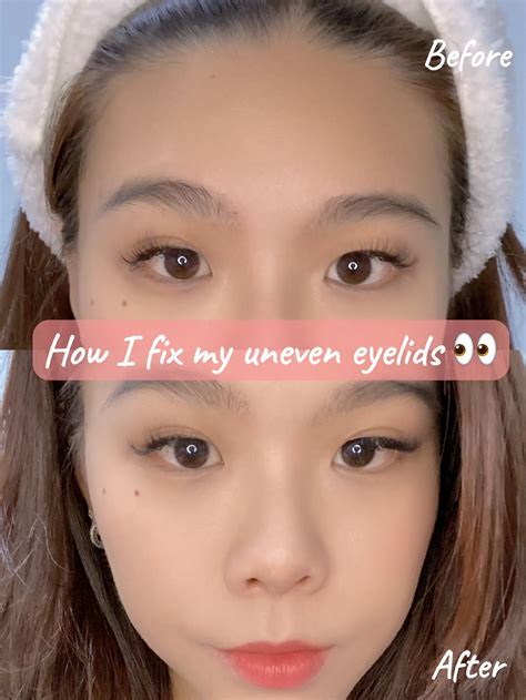 How To Fix Uneven Eyelids