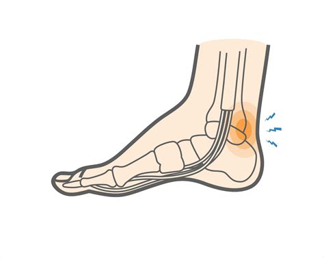 What Is Posterior Ankle Impingement & What Symptoms Should You Know?