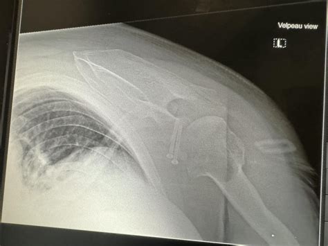 VELPEAU view : r/Radiology