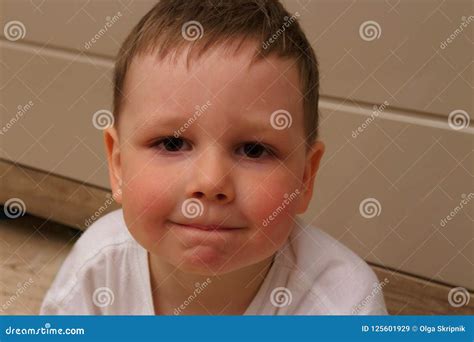 Portrait of a Child, a Boy, with Red Cheeks from the Temperature, from Allergies. the Child Has ...