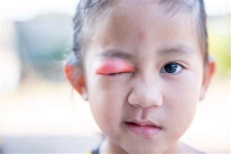 Are Styes Contagious? Causes, Risks & Prevention Tips