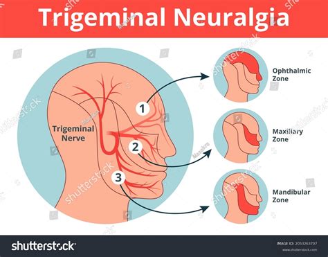 Trigeminal Neuralgia Trigger Points