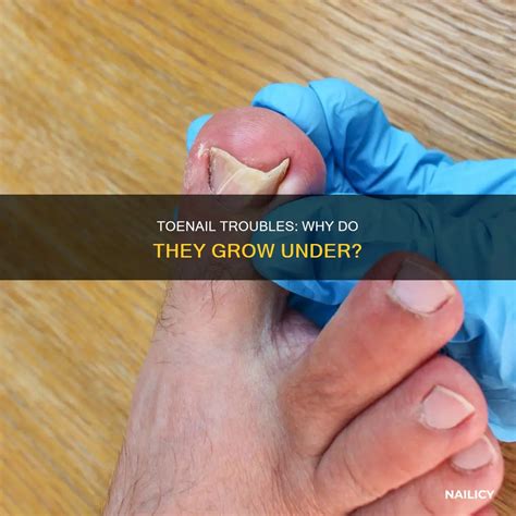 Toe Nail Growing Under Toenail