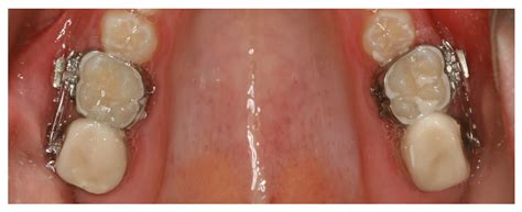 The Use of Selective Laser Melting in Mandibular Retrognathia Correction