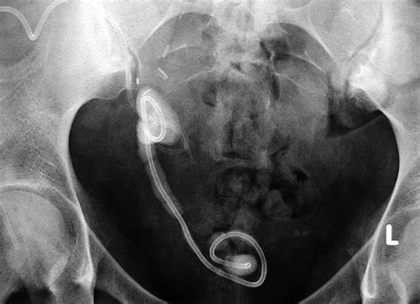 Successful Management of an “Overlooked” Ureteral Stent in a Transplant Kidney - Urology