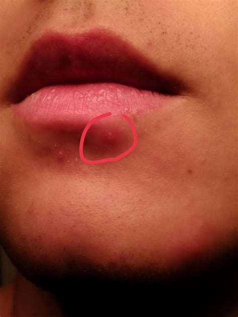 Cold sore or pimple? : r/Coldsore