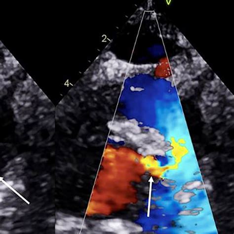 Incidence of Cardiorespiratory Instability Following Closure of ...