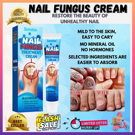 What Is The Best Nail Fungus Cream at Waldo Ross blog