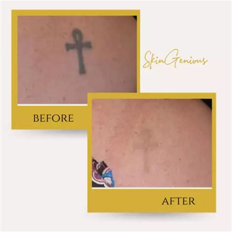 Best Laser Tattoo Removal Treatment in Mumbai with Latest Prices | Top ...