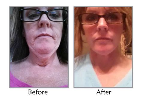 Facelift After Weight Loss in Salt Lake City | Utah Facial Plastics