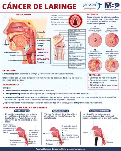 Cáncer de garganta - Infografía