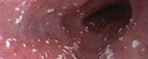 Bildergebnis für candida auris