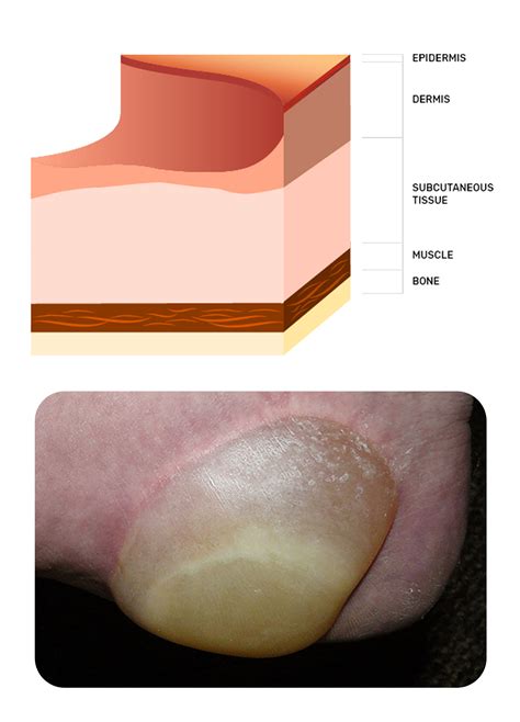 Wound Types: Pressure Injuries and Ulcerations | Ausmed