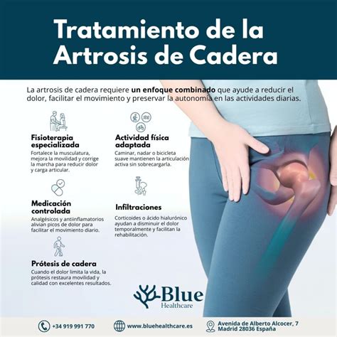 Artrosis de cadera: por qué duele la cadera, cuándo preocuparse y cómo ...