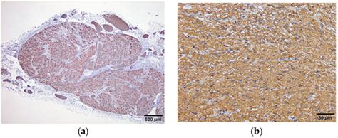 Percutaneous Fluoroscopic-Guided Celiac Plexus Approach: Results in a ...