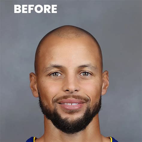 Stephen Curry Hair Transplant: Has the Australian Comedian Considered ...