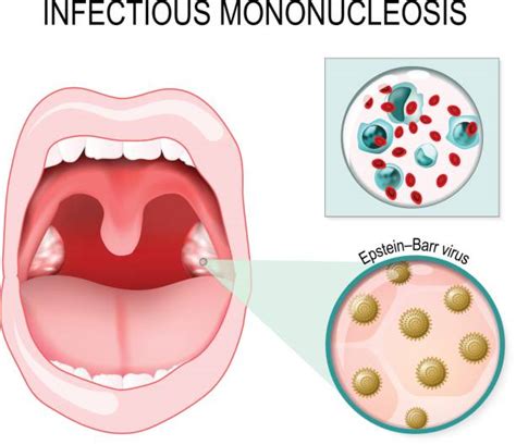 Infectious Mononucleosis Illustrations, Royalty-Free Vector Graphics ...