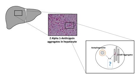 The Autophagy Pathway: A Critical Route in the Disposal of Alpha 1 ...
