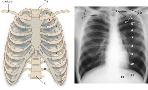 Slagter - Drawing and Chest X-ray of the ribs and clavicula - Latin ...