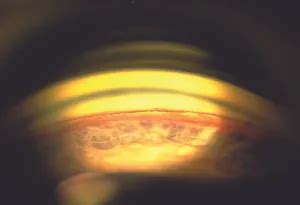 Angle Recession 的图像结果