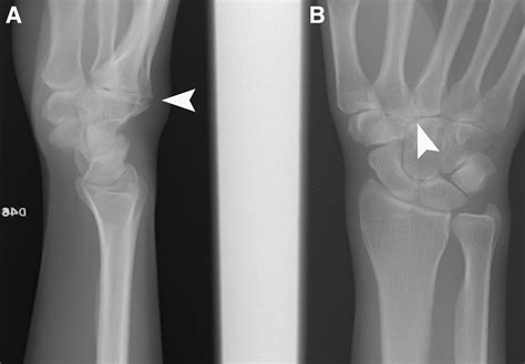 Endoscopic Resection of Carpometacarpal Boss and Synovectomy of the Second Carpometacarpal Joint ...