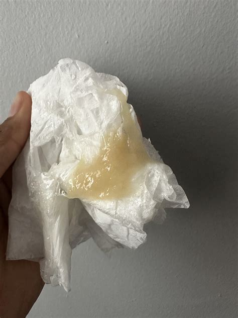 Clumpy Discharge 的图像结果