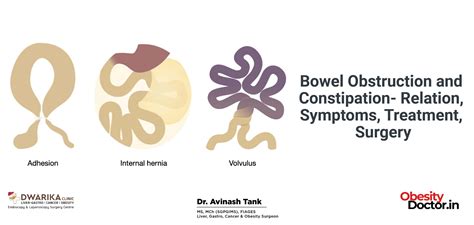 Bowel Obstruction and Constipation- Relation, Symptoms, Treatment, Surgery - Dr AvinashTank, is ...