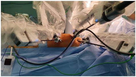 A Single Center Initial Experience with Robotic-Assisted Minimally ...