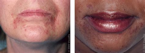 Red Spots On Lips After Kissing Someone - Infoupdate.org