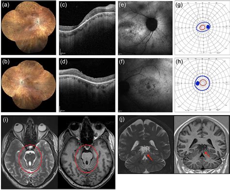 Mild Clinical Presentation of Joubert Syndrome in a Male Adult Carrying ...