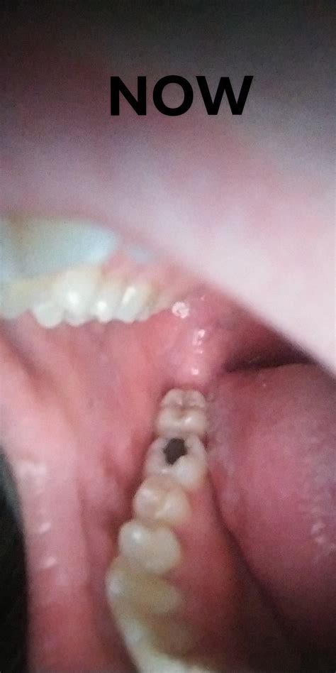 Can accidentally biting your cheek cause serum-filled blisters on it? Asking for confirmation on ...
