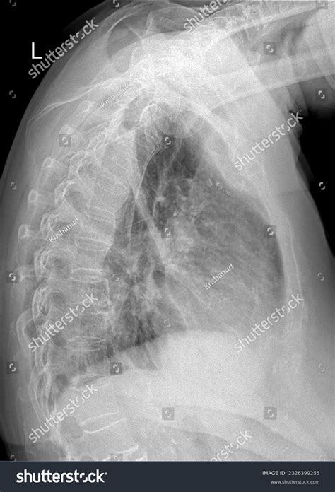 Normal Lateral Chest X Ray Male