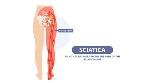 Buttock Muscle Pain: Yoga for Sciatica - YogaUOnline