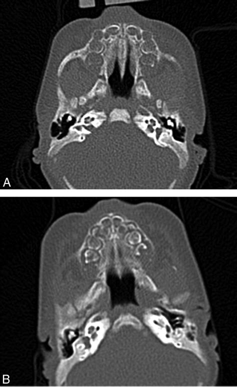 Congenital Nasal Pyriform Aperture Stenosis: Evidence of Premature Fusion of the Midline Palatal ...