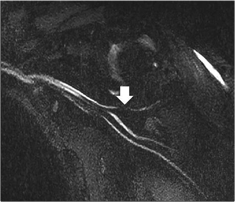 Peripheral Nerve Imaging - Magnetic Resonance Imaging Clinics