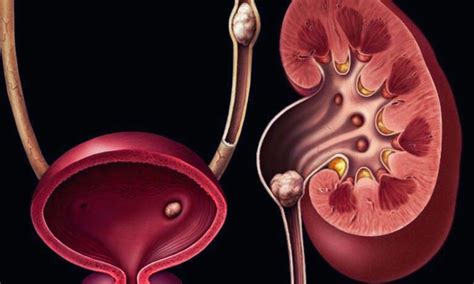 Hematuria Not a Reliable Indicator in Pediatric Kidney Stones, Suggests ...