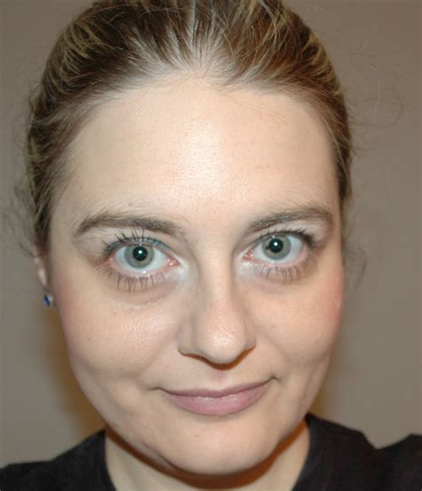 List 90+ Pictures Facial Feature Vascular Ehlers-danlos Syndrome Pictures Sharp